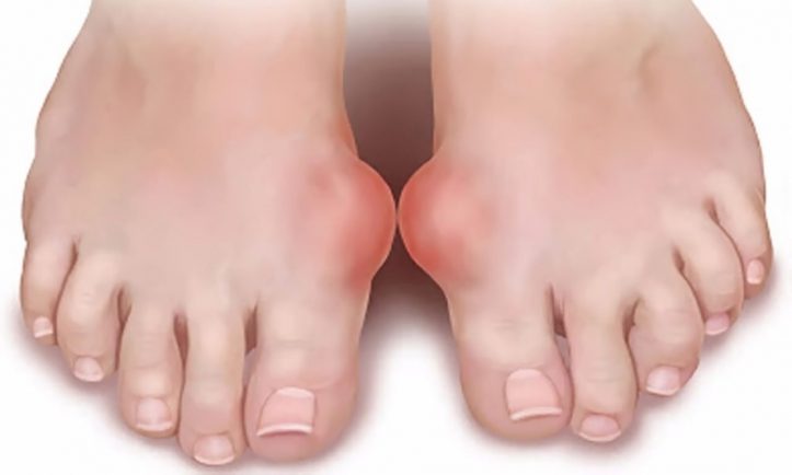 What is Gout?